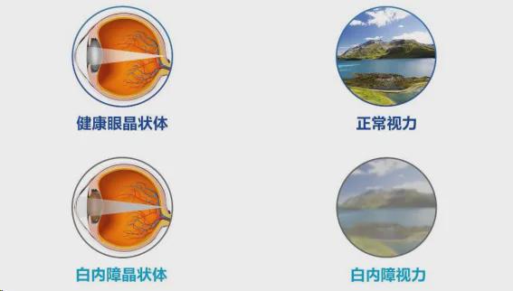 哪些患者适合选择飞秒激光辅助白内障手术？