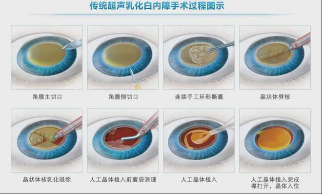 哪些患者适合选择飞秒激光辅助白内障手术？(图2)